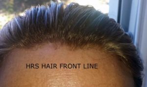 hrs protesi capelli frontale