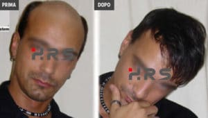 Protesi capelli prima e dopo