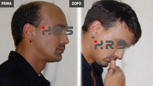 hrs protesi capelli opinioni