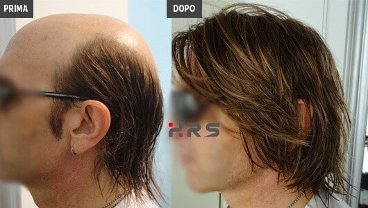 Protesi capelli prima e dopo