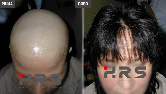 Protesi capelli prima e dopo