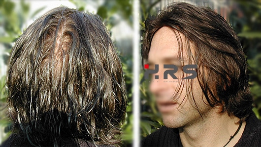 Protesi capelli prima e dopo