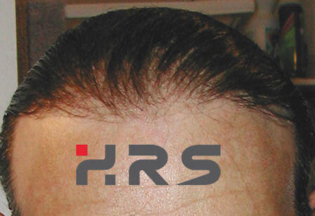 protesi capelli HRS