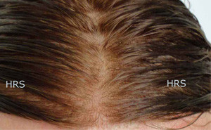 protesi capelli dermo 2010 hrs