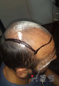 calco protesi capelli