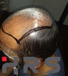 calco protesi capelli