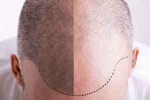 calco protesi capelli