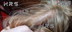 protesi capelli prezzi bassi